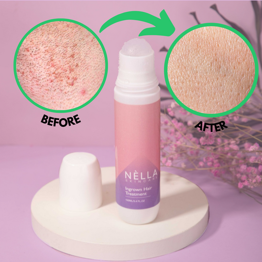 NELLA Ingrown Hair Treatment & Razor Bump Solution
