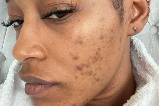 5 tips to fix uneven skin tone due to acne scars: